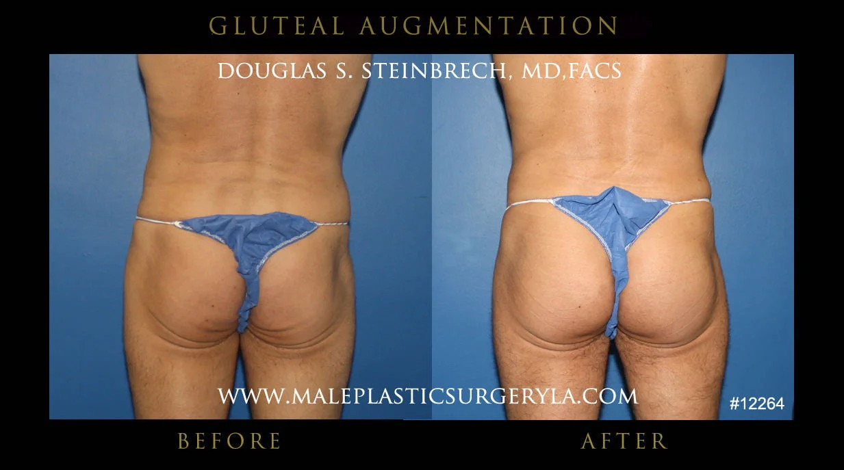 Gluteal Buttock Implants - Before & After Photos