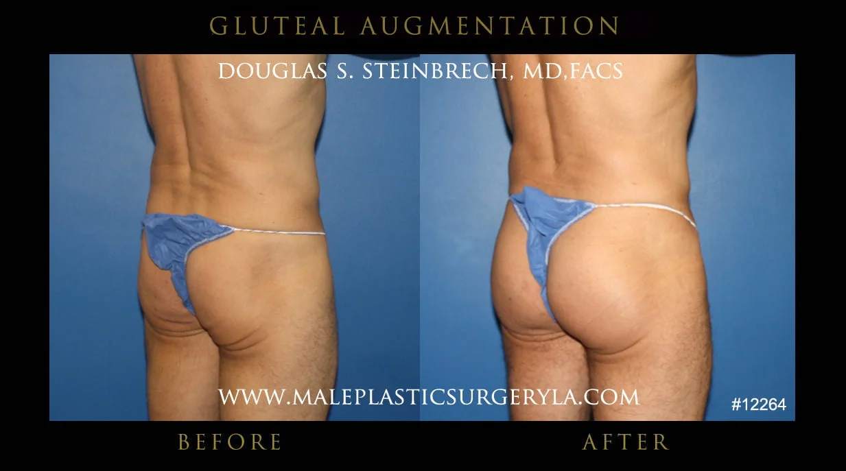 Gluteal Buttock Implants - Before & After Photos