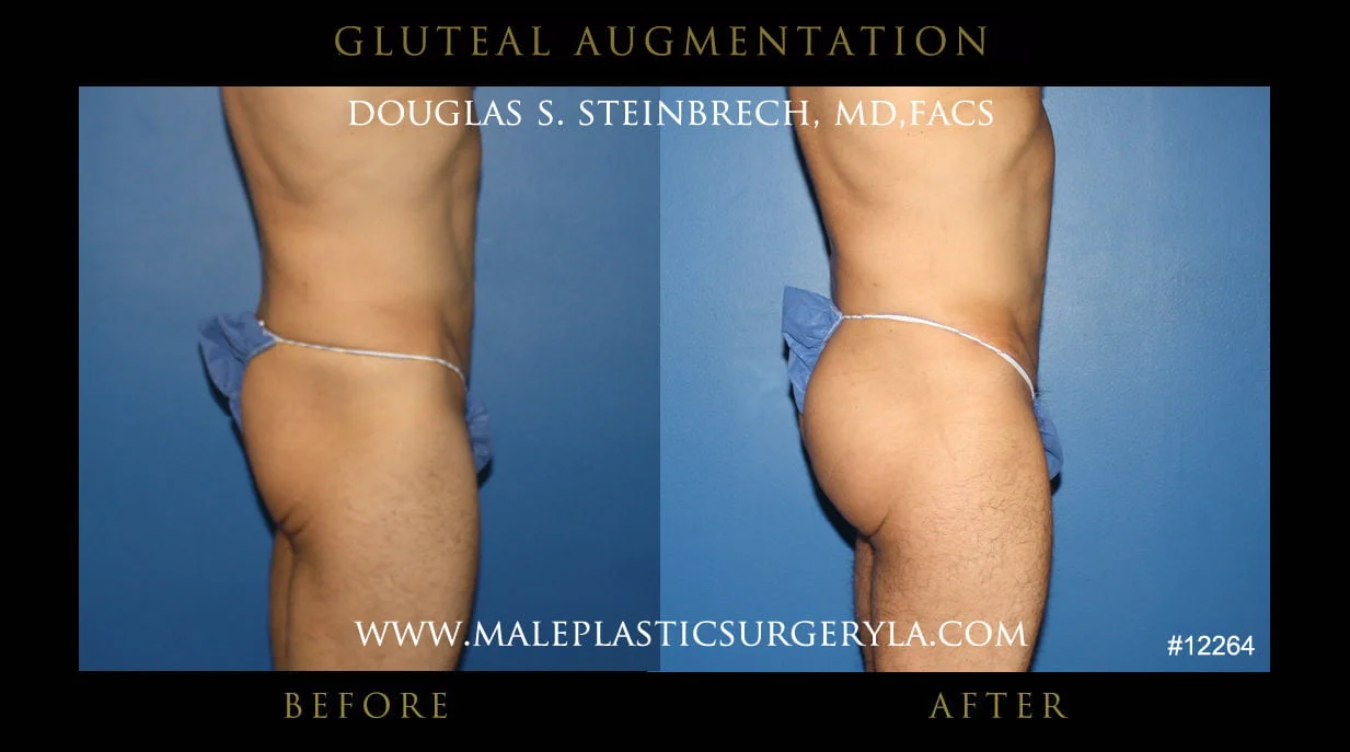 Gluteal Buttock Implants - Before & After Photos