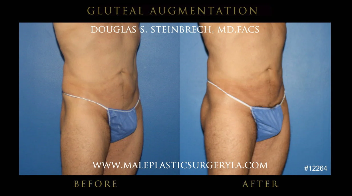 Gluteal Buttock Implants - Before & After Photos