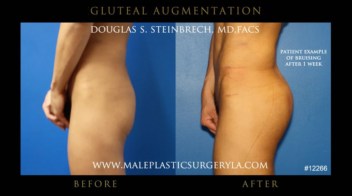 Gluteal Buttock Implants - Before & After Photos