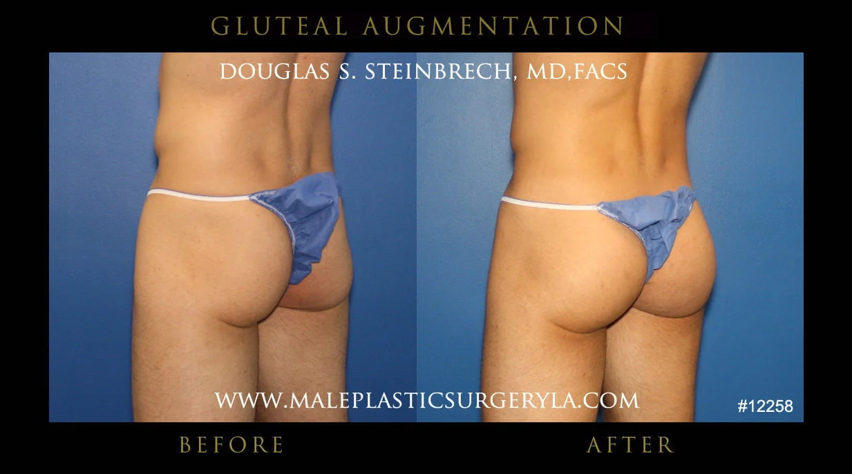 Gluteal Buttock Implants - Before & After Photos