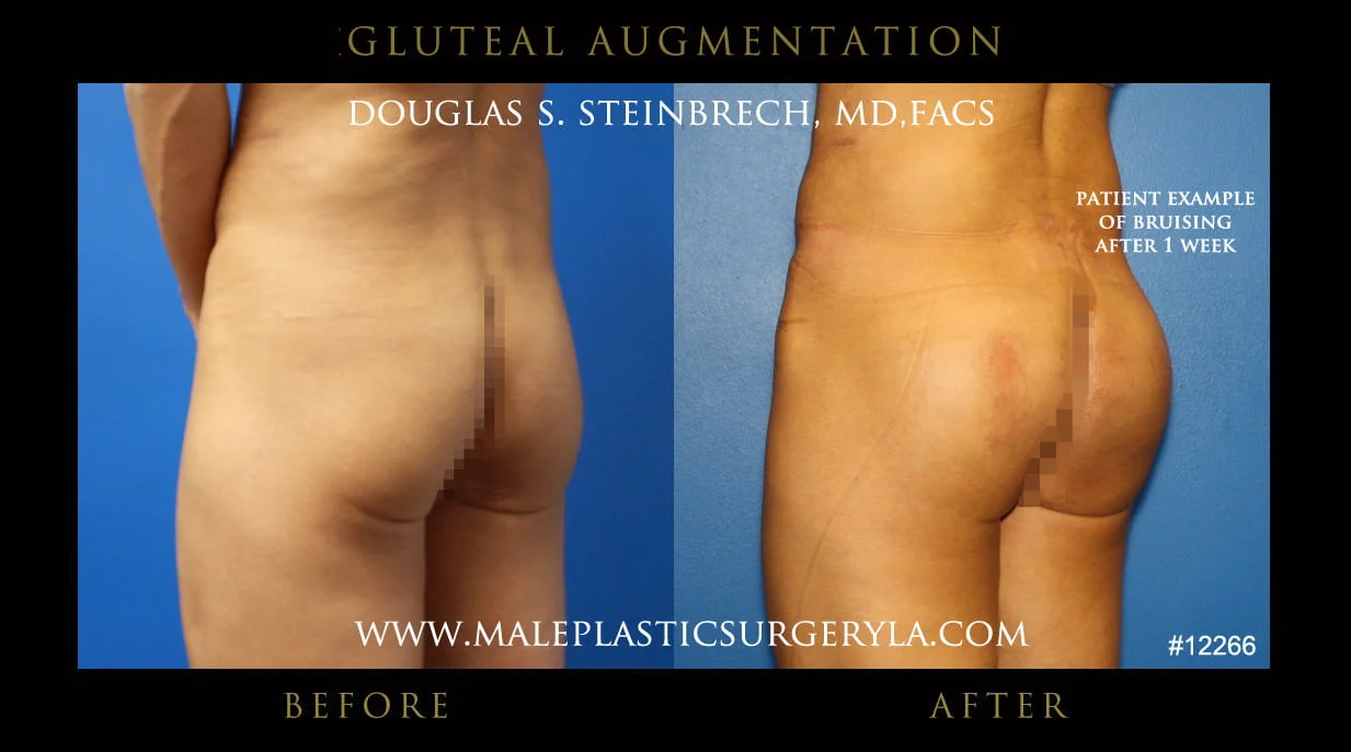 Gluteal Buttock Implants - Before & After Photos