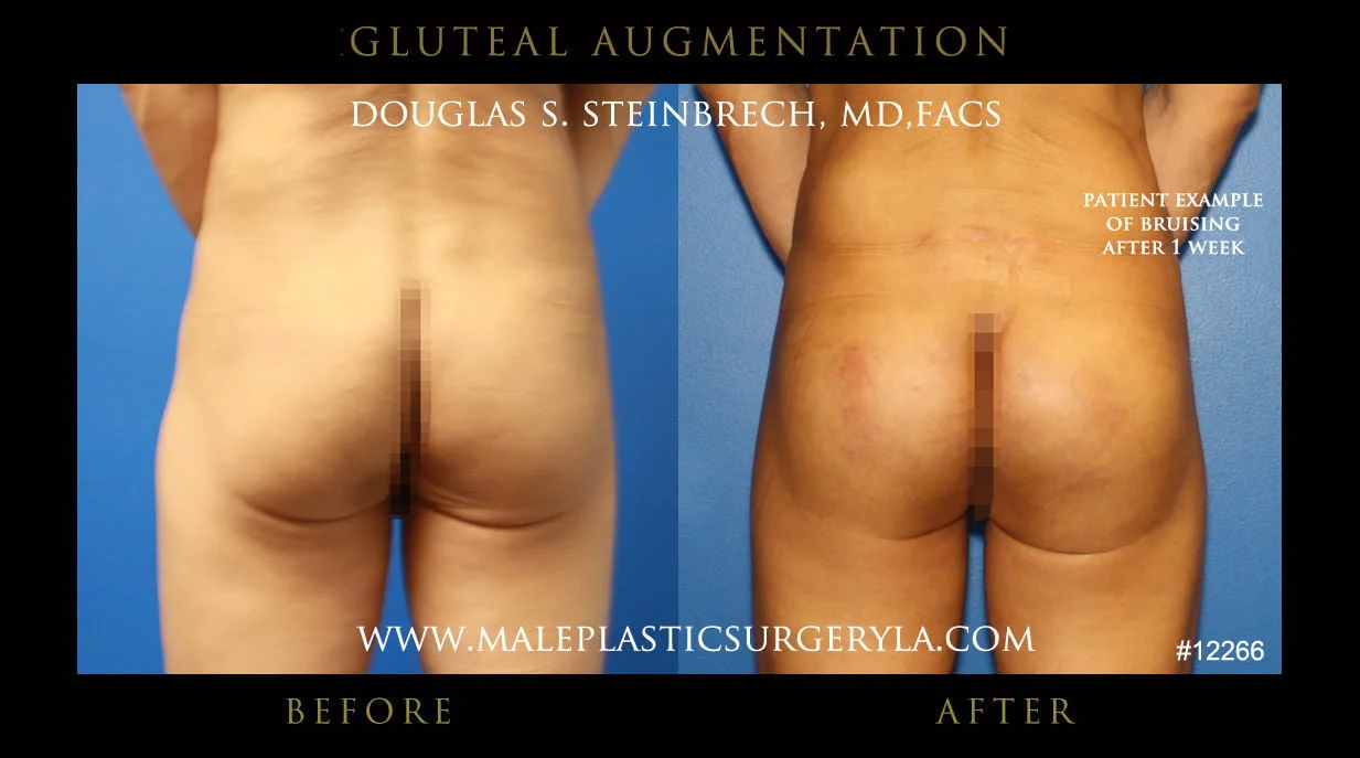 Gluteal Buttock Implants - Before & After Photos