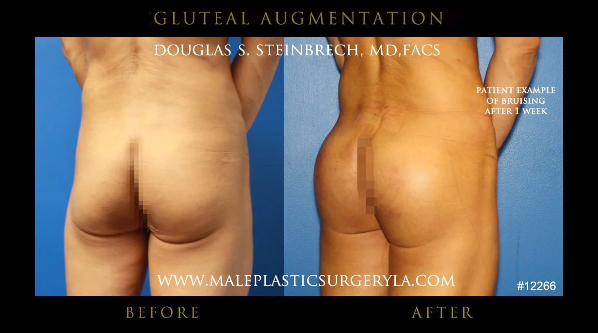 Gluteal Buttock Implants - Before & After Photos