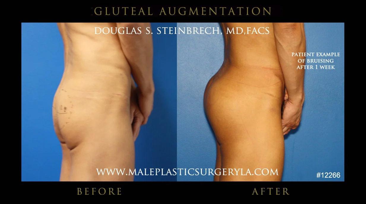 Gluteal Buttock Implants - Before & After Photos