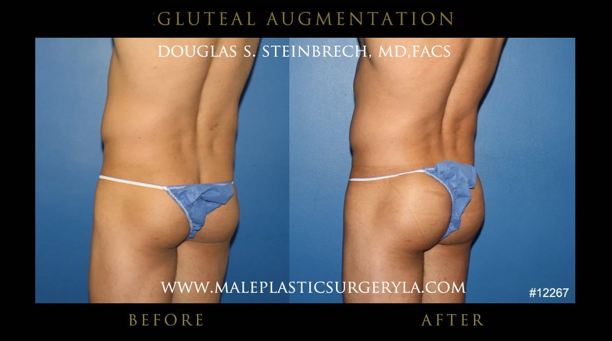 Gluteal Buttock Implants - Before & After Photos