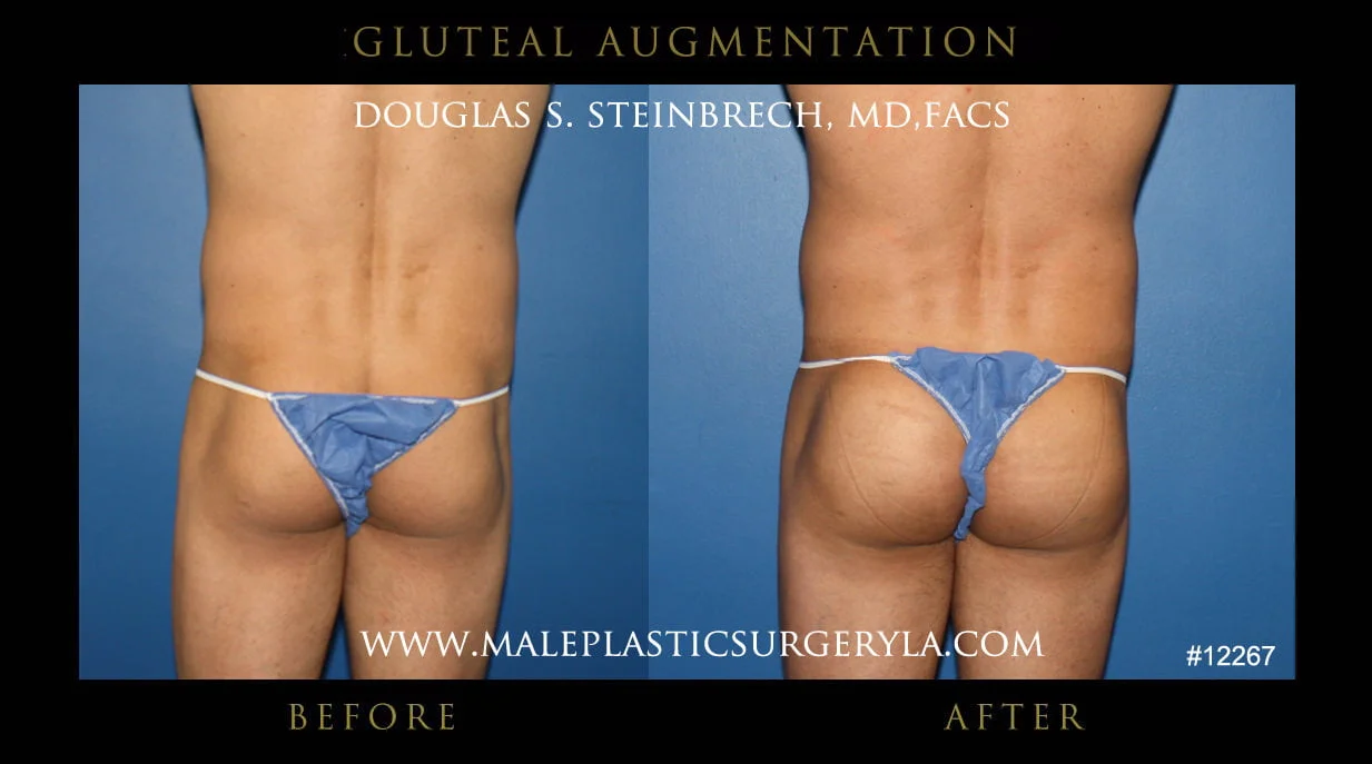 Gluteal Buttock Implants - Before & After Photos