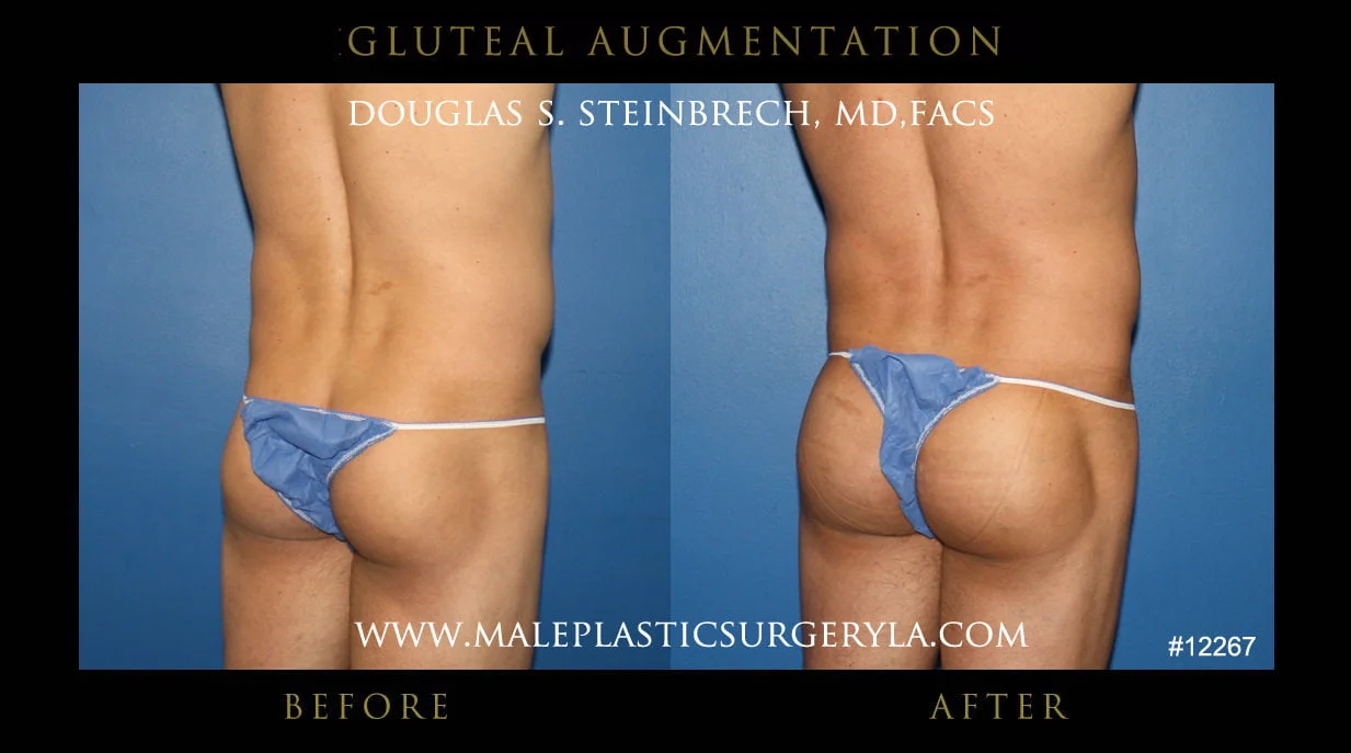 Gluteal Buttock Implants - Before & After Photos