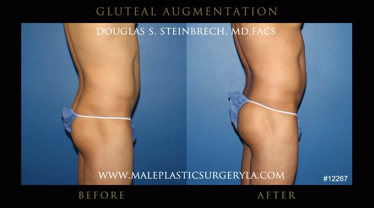 Gluteal Buttock Implants - Before & After Photos