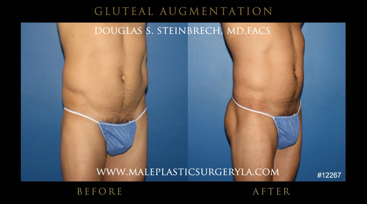 Gluteal Buttock Implants - Before & After Photos