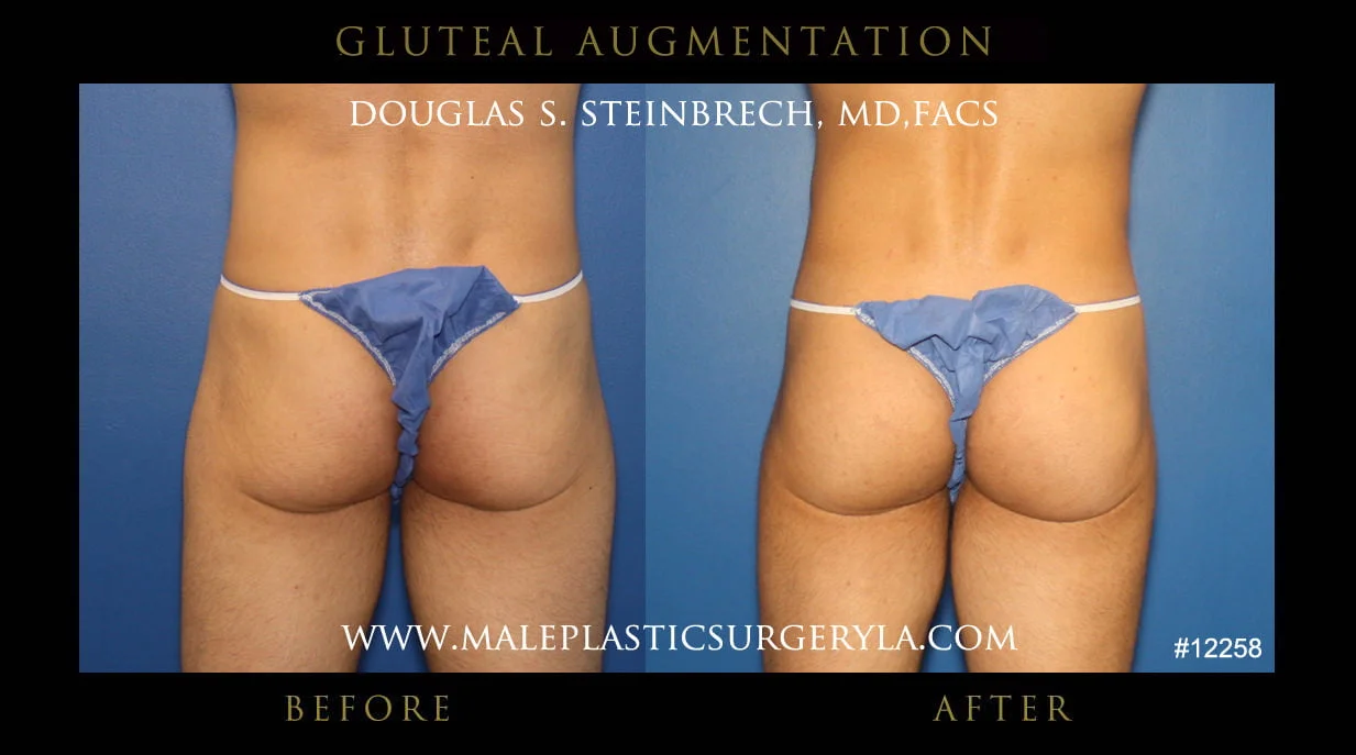 Gluteal Buttock Implants - Before & After Photos