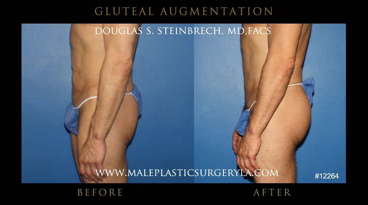 Gluteal Buttock Implants - Before & After Photos