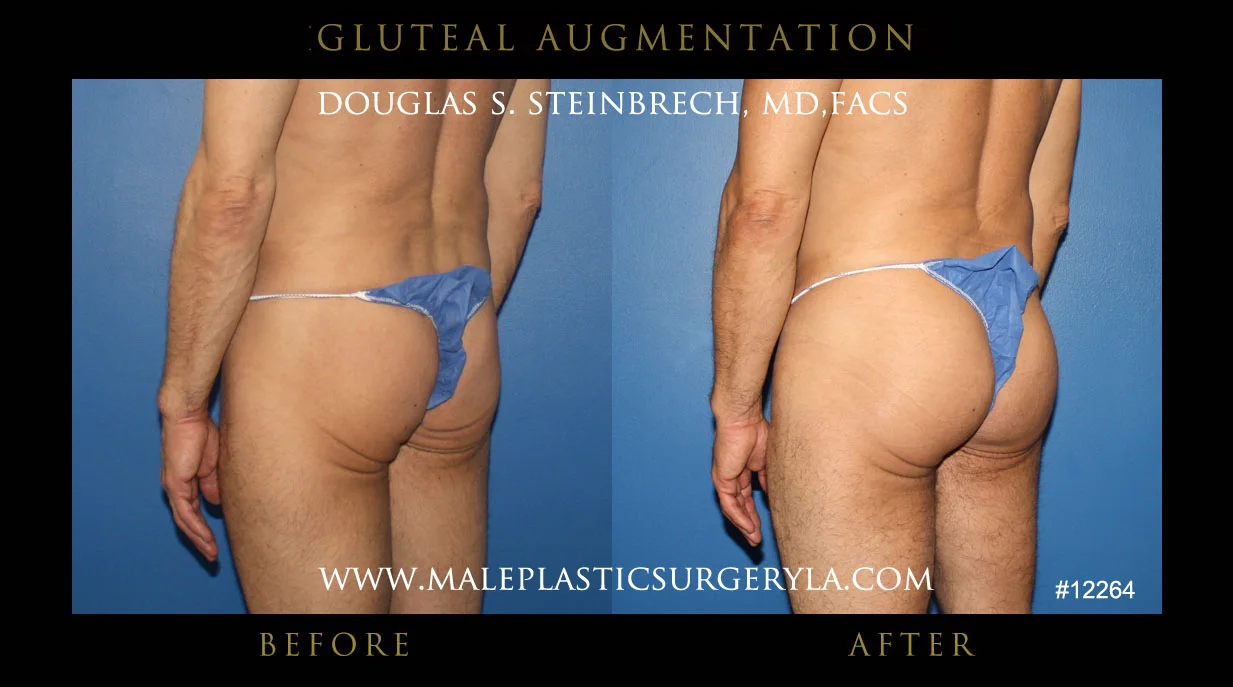 Gluteal Buttock Implants - Before & After Photos