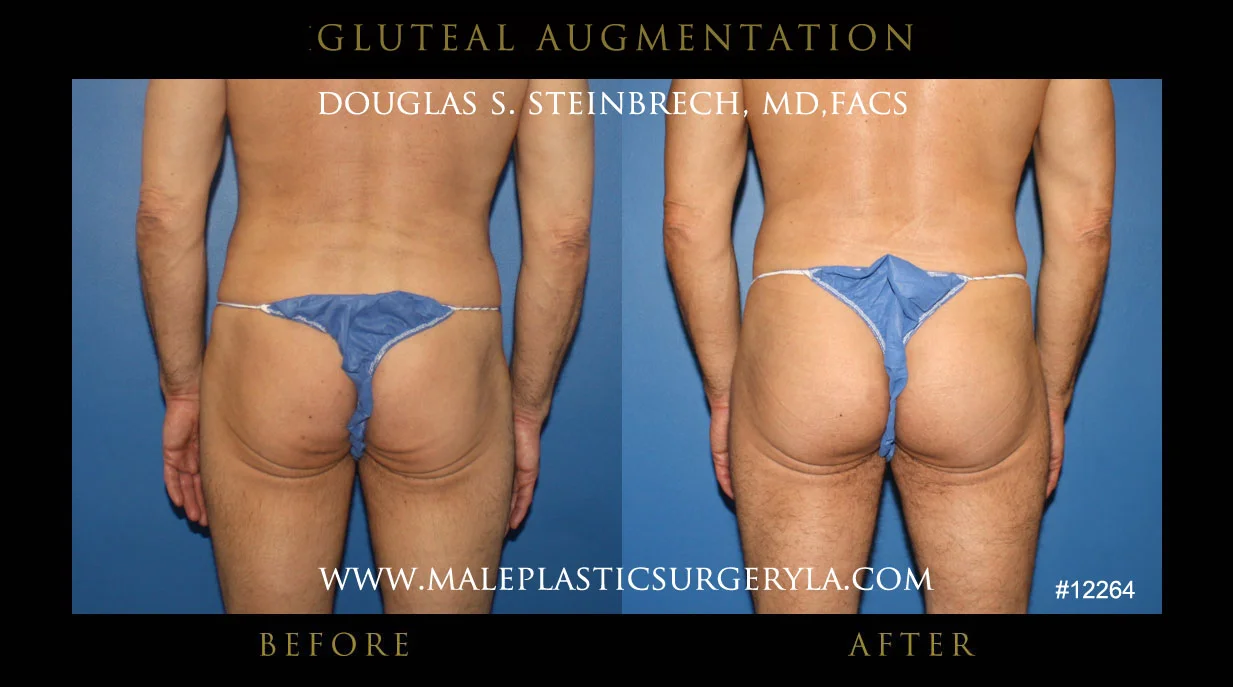 Gluteal Buttock Implants - Before & After Photos