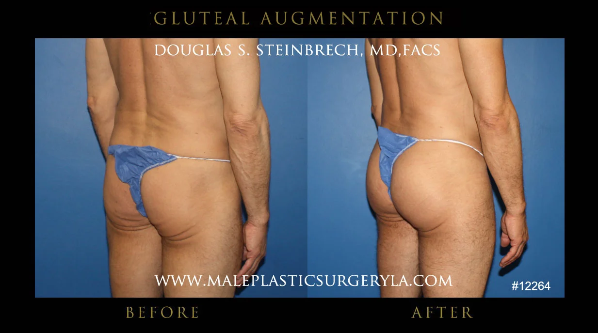 Gluteal Buttock Implants - Before & After Photos