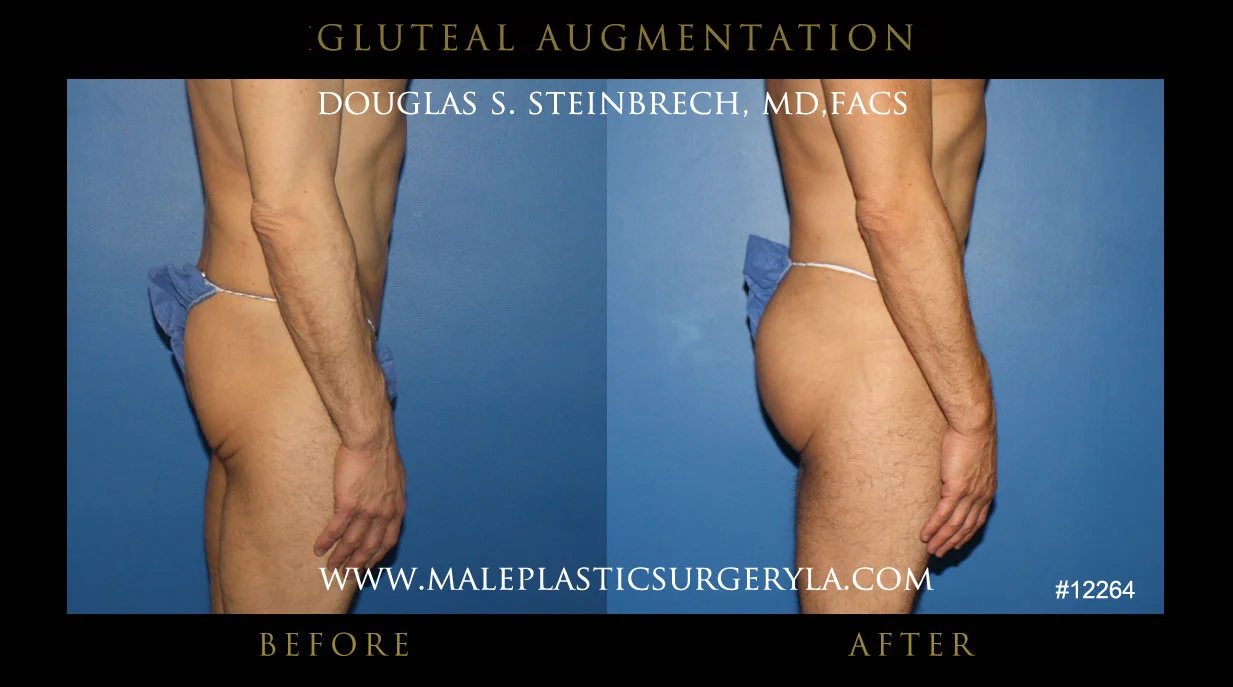 Gluteal Buttock Implants - Before & After Photos