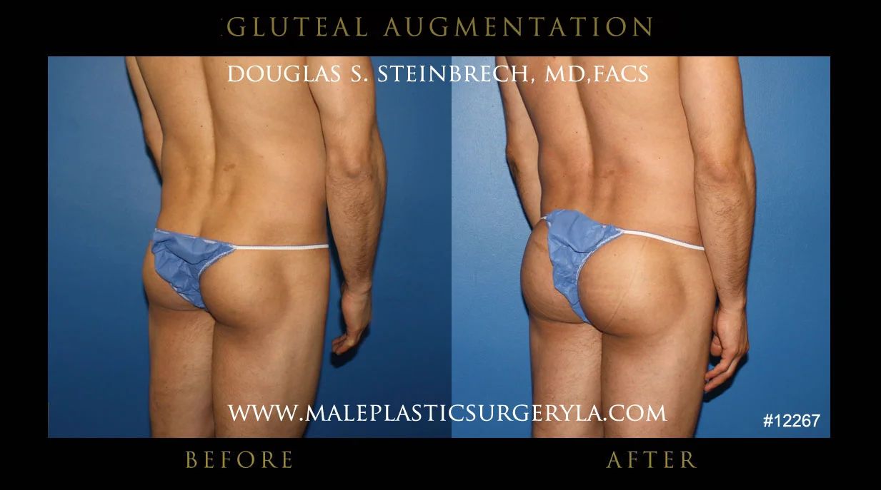 Gluteal Buttock Implants - Before & After Photos