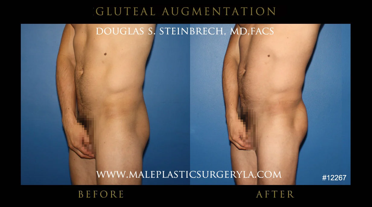 Gluteal Buttock Implants - Before & After Photos