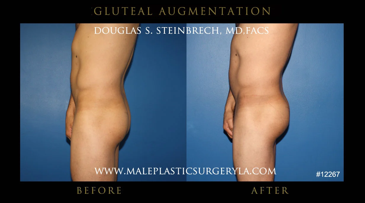 Gluteal Buttock Implants - Before & After Photos