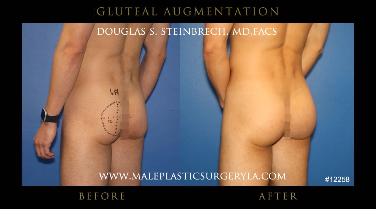 Gluteal Buttock Implants - Before & After Photos