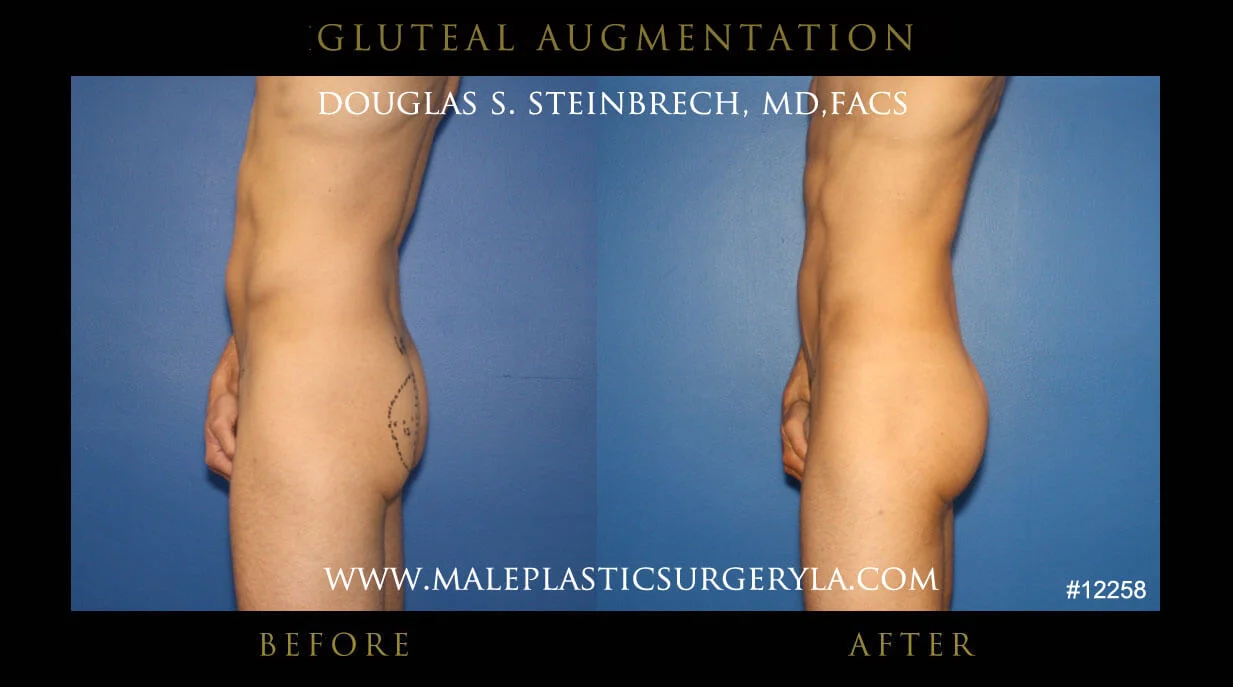 Gluteal Buttock Implants - Before & After Photos