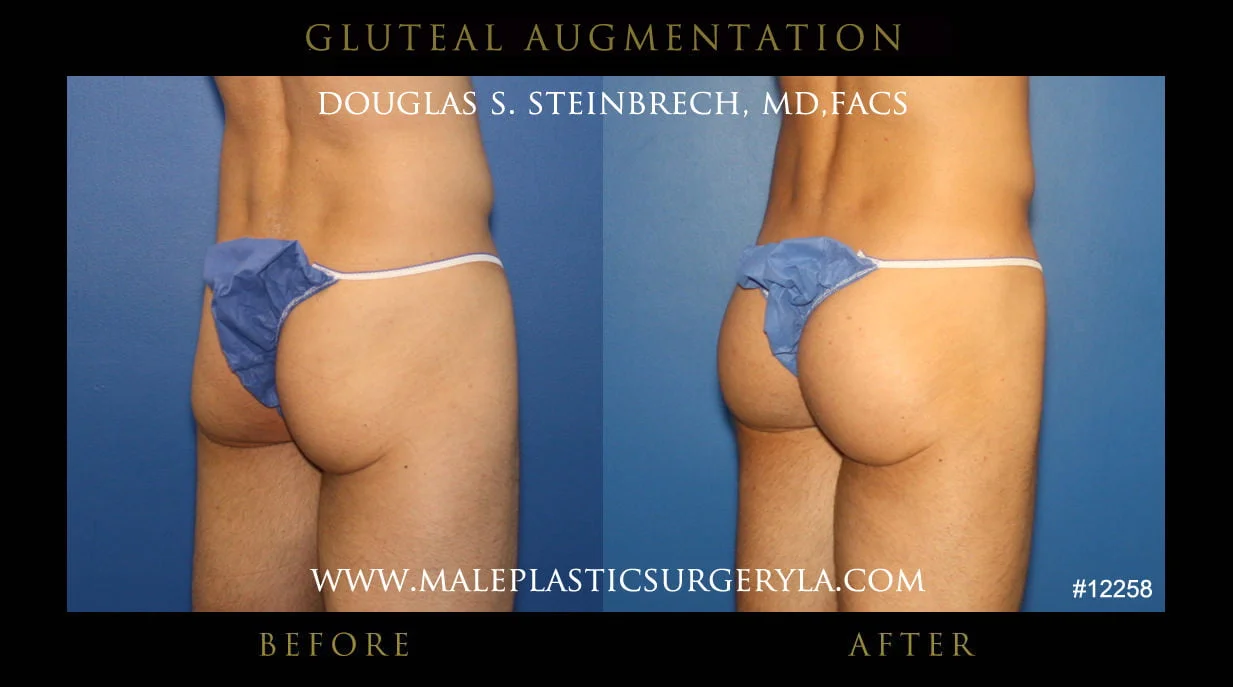 Gluteal Buttock Implants - Before & After Photos