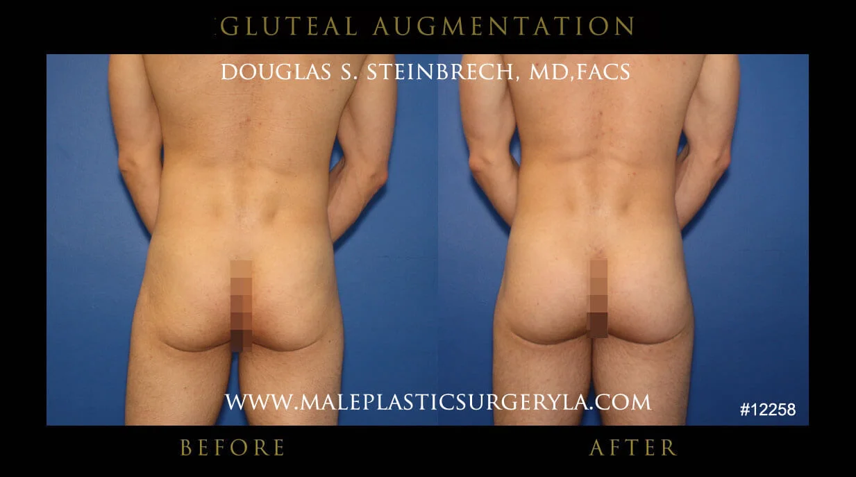 Gluteal Buttock Implants - Before & After Photos