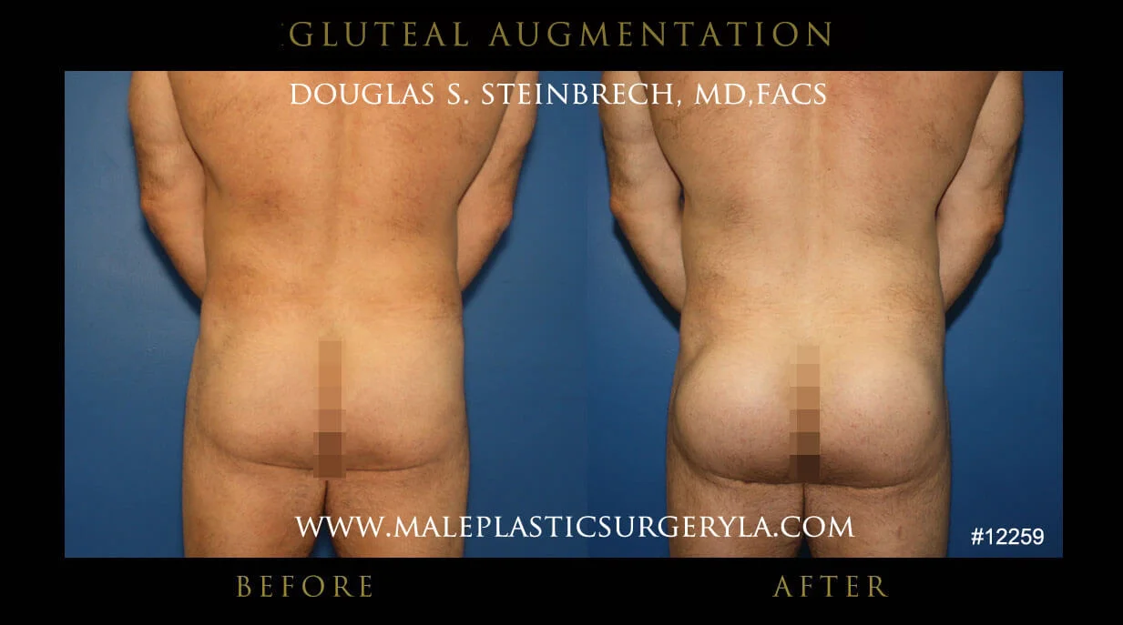 Gluteal Buttock Implants - Before & After Photos