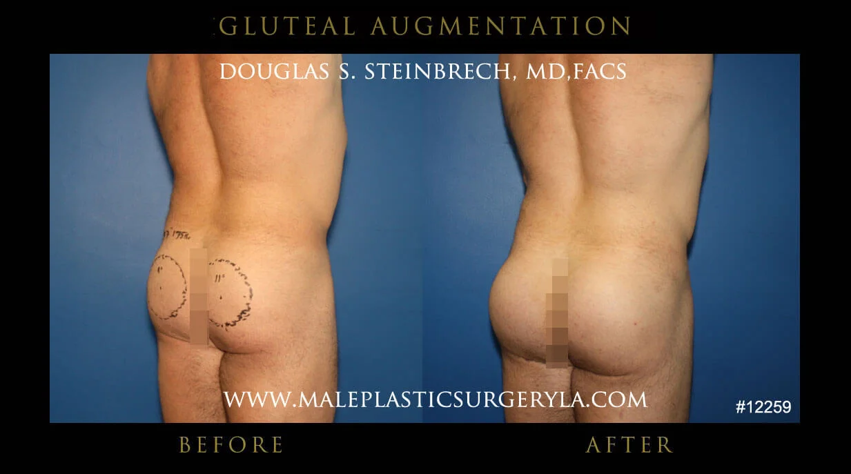 Gluteal Buttock Implants - Before & After Photos