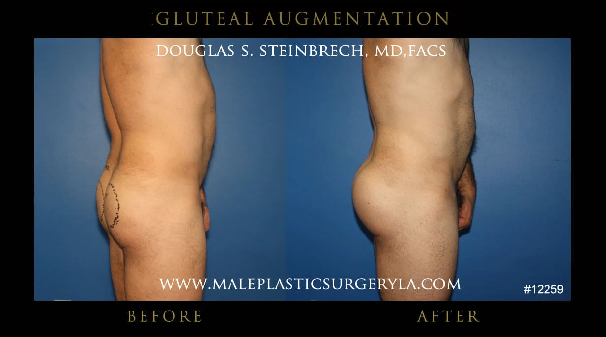 Gluteal Buttock Implants - Before & After Photos