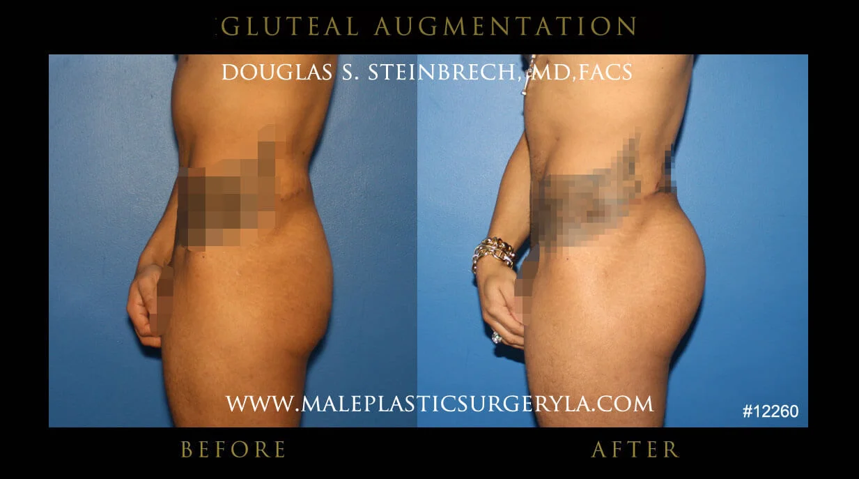 Gluteal Buttock Implants - Before & After Photos