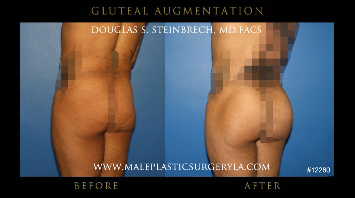 Gluteal Buttock Implants - Before & After Photos