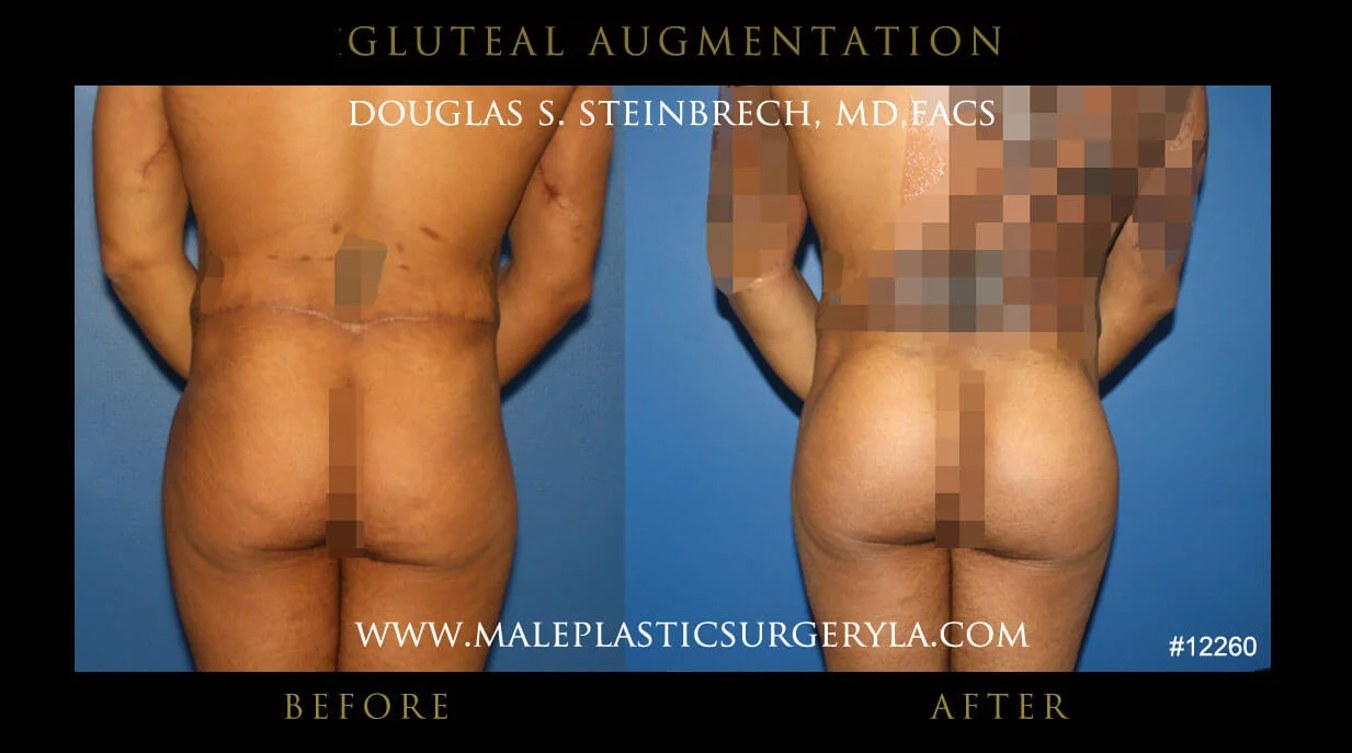 Gluteal Buttock Implants - Before & After Photos