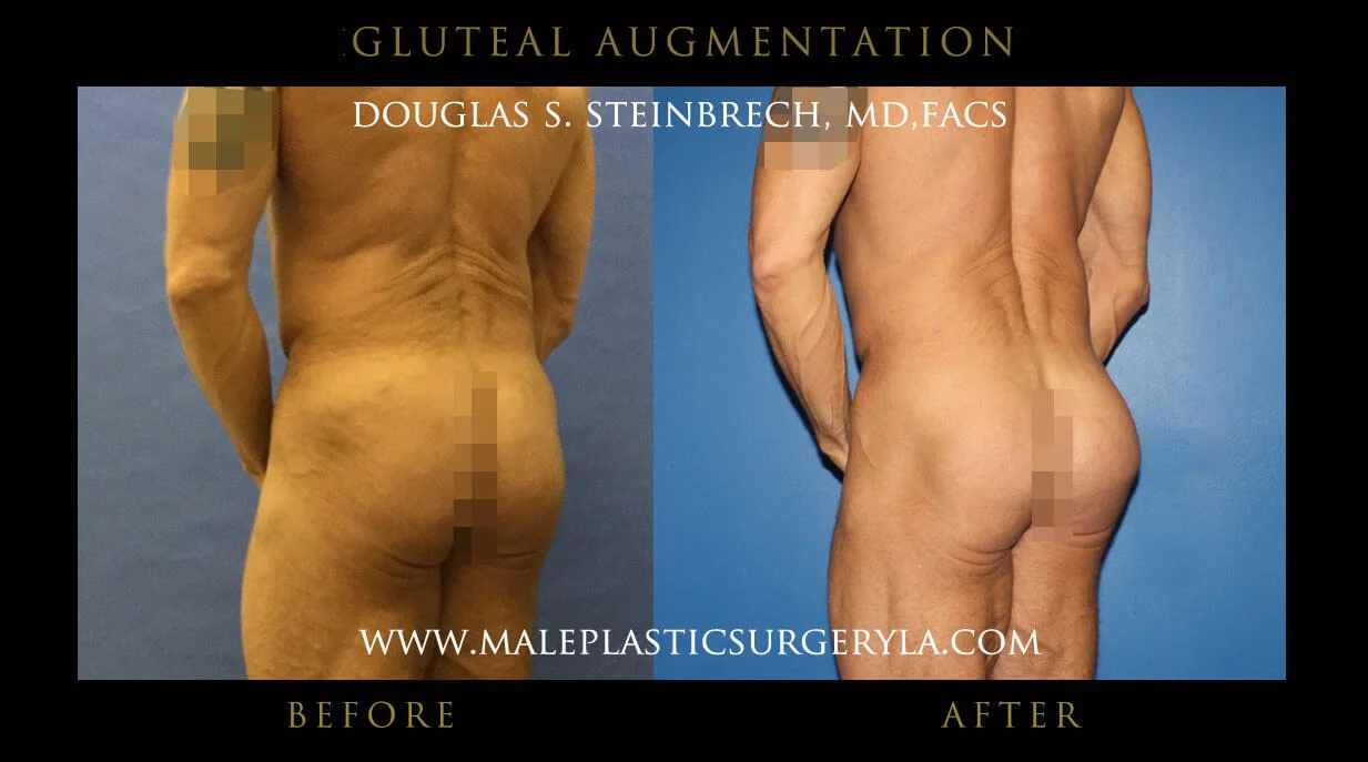 Gluteal Buttock Implants - Before & After Photos