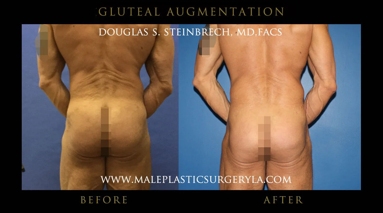 Gluteal Buttock Implants - Before & After Photos