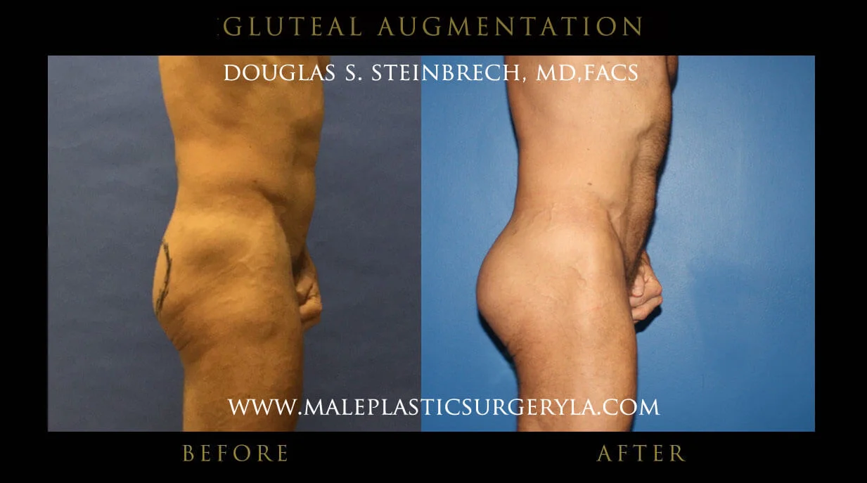 Gluteal Buttock Implants - Before & After Photos