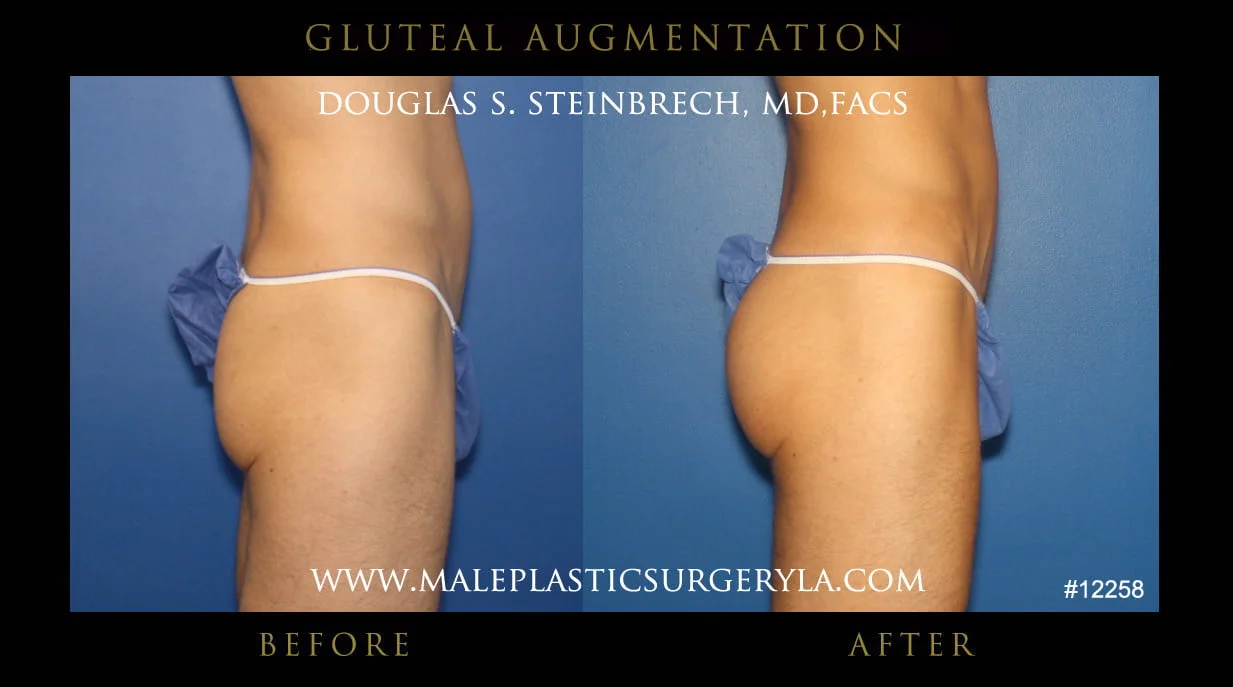 Gluteal Buttock Implants - Before & After Photos