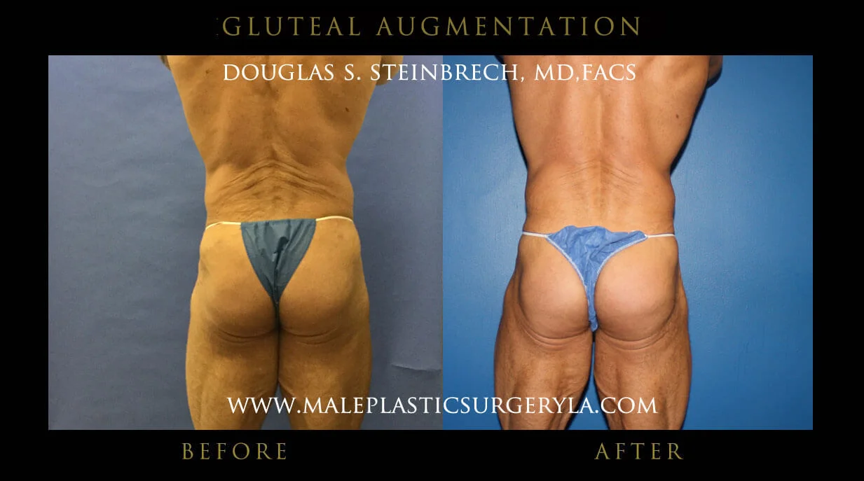 Gluteal Buttock Implants - Before & After Photos