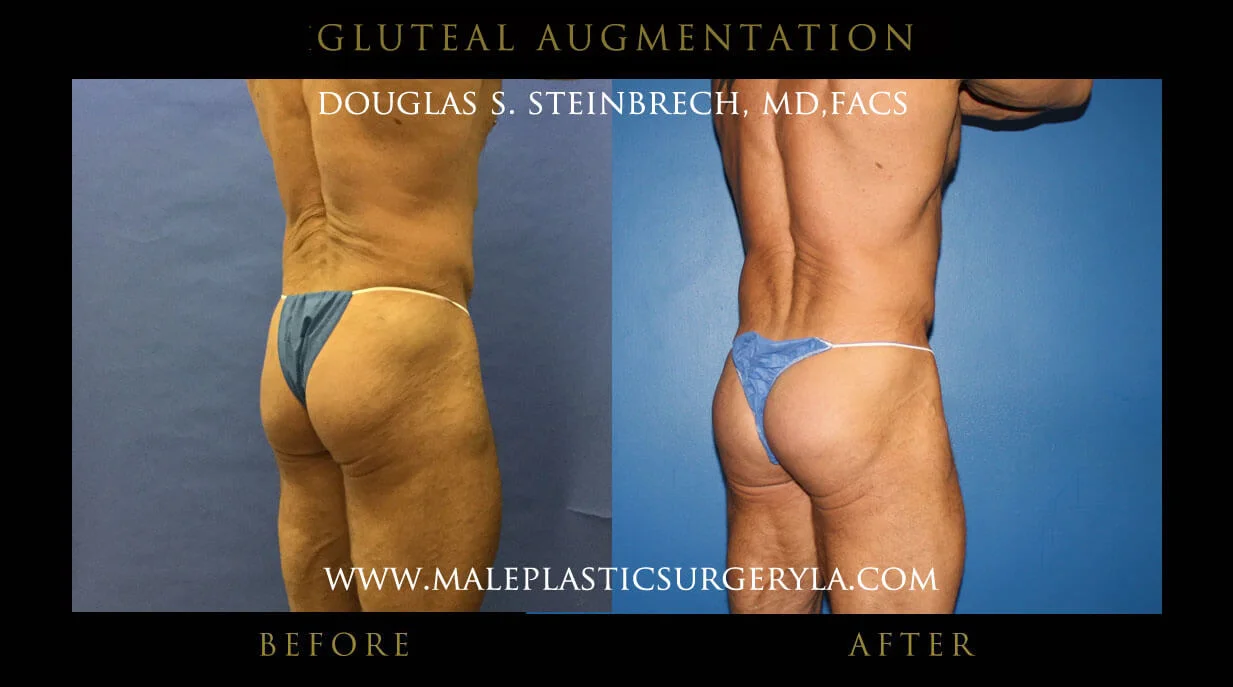 Gluteal Buttock Implants - Before & After Photos