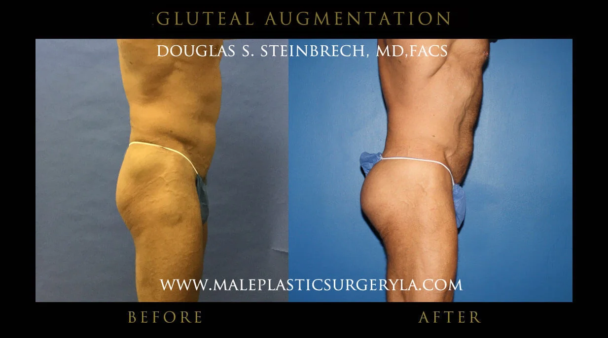 Gluteal Buttock Implants - Before & After Photos