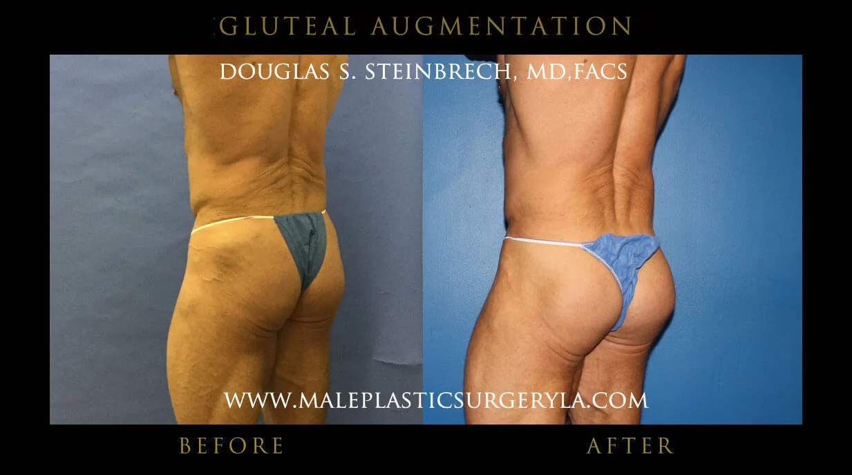 Gluteal Buttock Implants - Before & After Photos