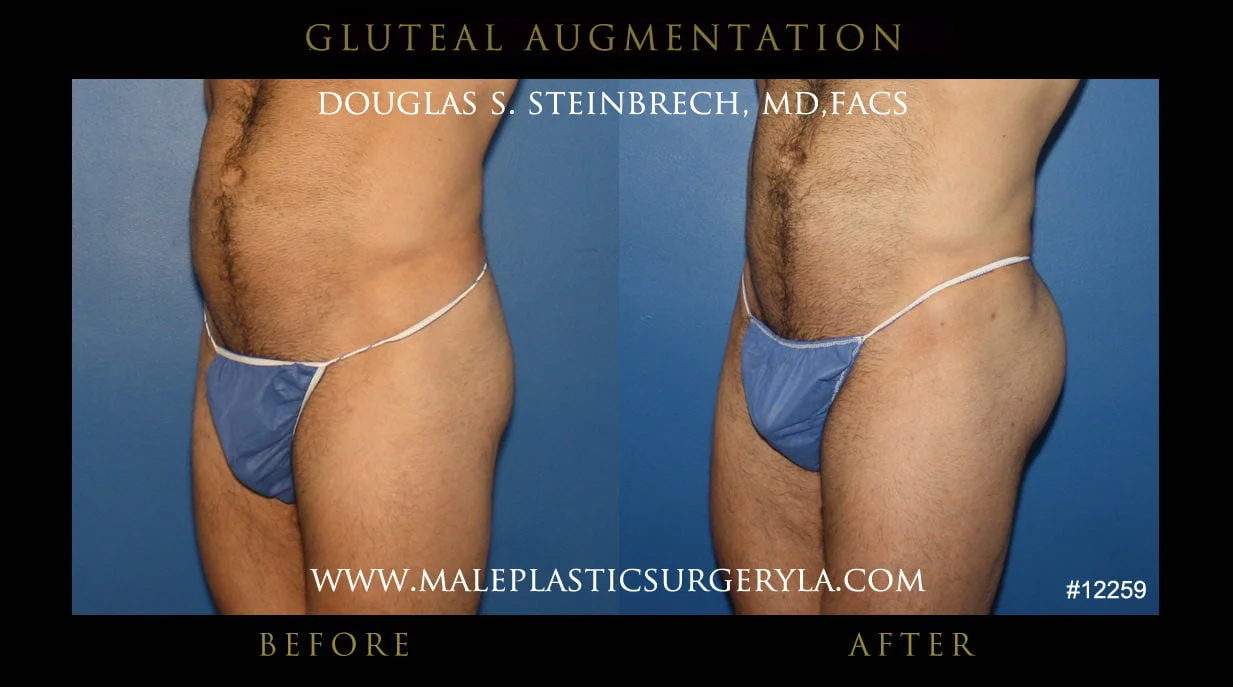 Gluteal Buttock Implants - Before & After Photos