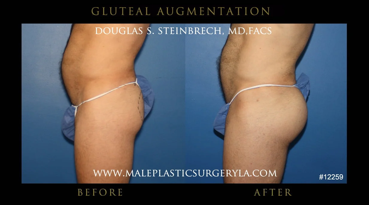 Gluteal Buttock Implants - Before & After Photos