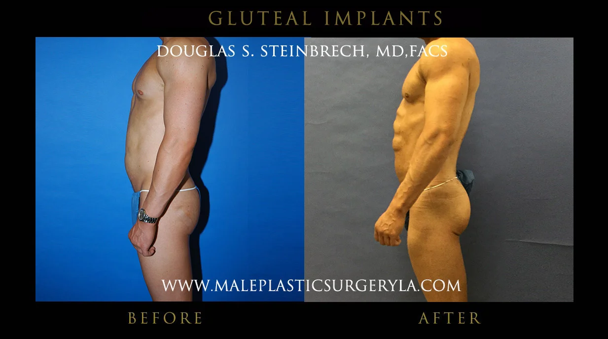 Gluteal Buttock Implants - Before & After Photos