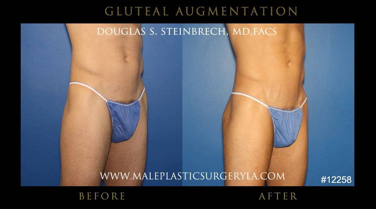 Gluteal Buttock Implants - Before & After Photos