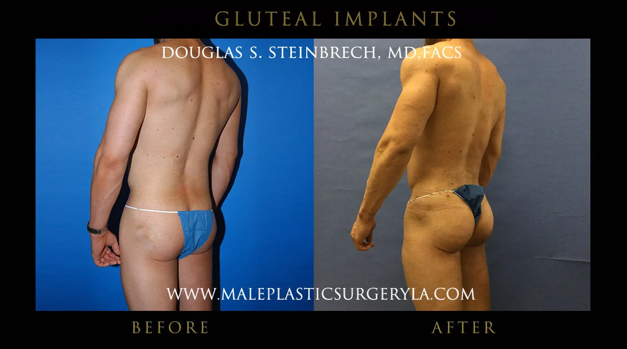 Gluteal Buttock Implants - Before & After Photos