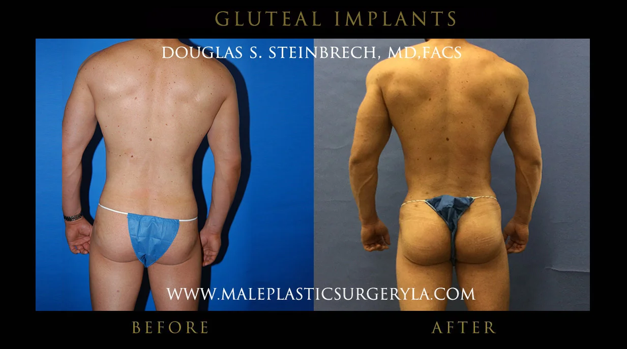 Gluteal Buttock Implants - Before & After Photos