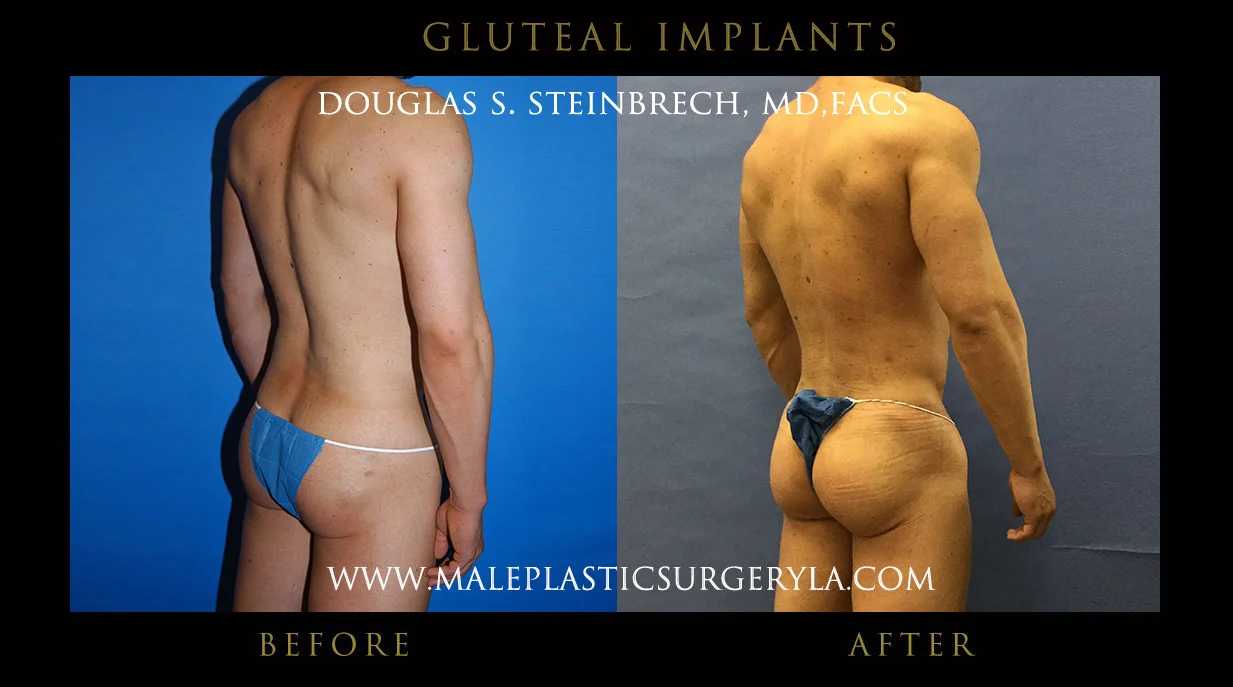 Gluteal Buttock Implants - Before & After Photos