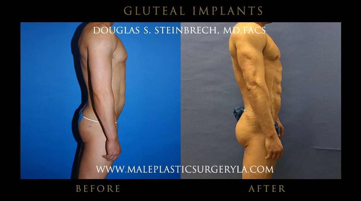 Gluteal Buttock Implants - Before & After Photos